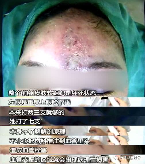 90后女子注射6针玻尿酸致残,女大学生打玻尿酸