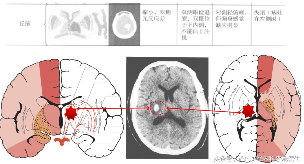 脑出血李医生,脑出血病例分析及答案