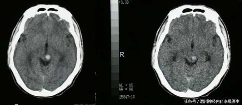 脑出血李医生,脑出血病例分析及答案