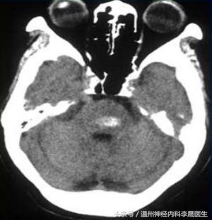 脑出血李医生,脑出血病例分析及答案