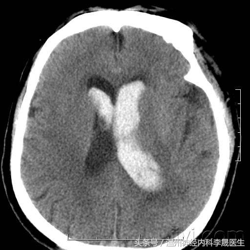 脑出血李医生,脑出血病例分析及答案