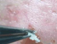 拔黑头粉刺过程细节,挤痘痘和拔黑头手法