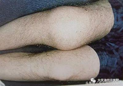 厉害了！“玻璃人”在总院获救