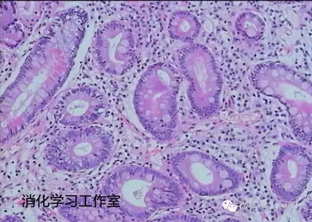 肠上皮化生会引发什么病,胃部肠上皮化生一定会癌变吗