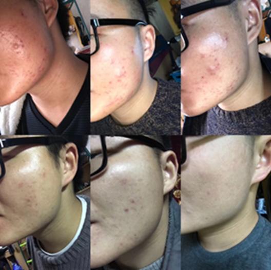 仔细看完他的经历,痘痘*疮痤**一去不复返!