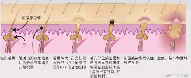 只有长痘才知道痘痘有多难治,要知道痘痘的根源