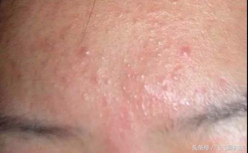 各种痘痘的类型及治疗方法,不同类型痘痘的症状及改善方法