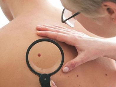 嘴上一个黑痣,嘴上有一颗很大的痣去掉后的图