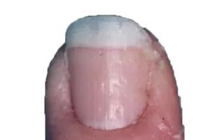 怎么从指甲上看健康图解,从指甲看疾病的图片说明