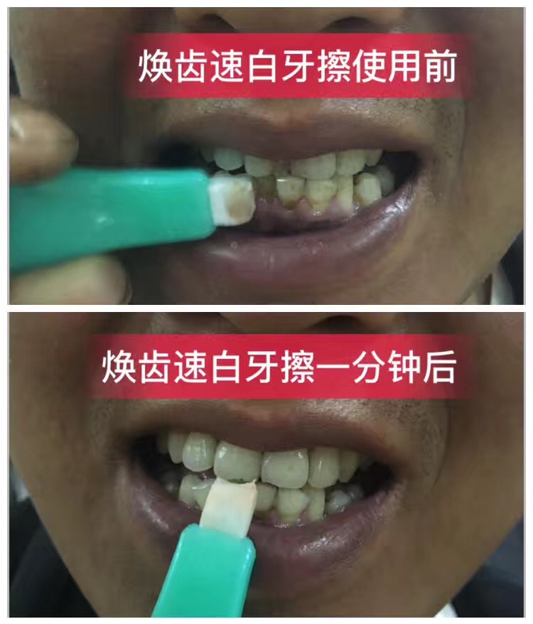 牙齿美白速效去黄牙烟渍神器,清洁牙渍美白牙齿
