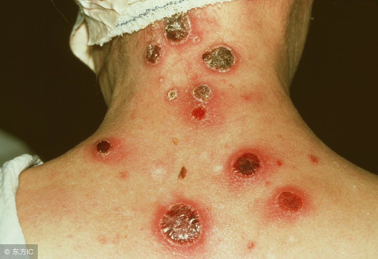 怀孕可以查出孩子患有梅毒吗,怀孕查出梅毒怎么处理