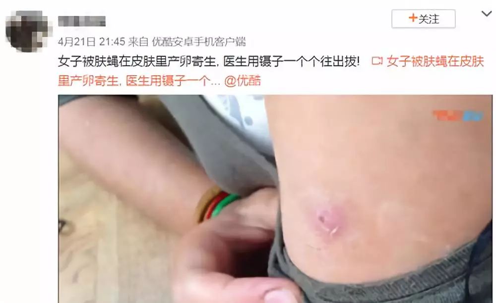 吃小龙虾从身体上取出虫子视频,女子体内取出一米虫子后续