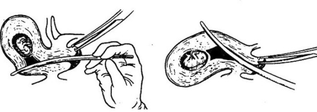 疤痕子宫可以生三胎剖宫产吗,一次剖宫产会有两道疤痕吗