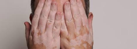 邯郸中医院发现白癜风,邯郸白癜风需要在哪里治疗