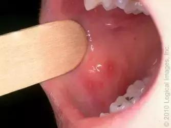 口腔疱疹发热怎么办,小孩发热口腔有疱疹