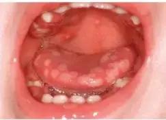 口腔疱疹发热怎么办,小孩发热口腔有疱疹