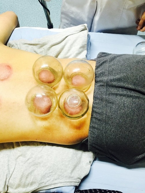 拔罐后罐印代表什么配图,拔罐时出现罐印红是怎么回事