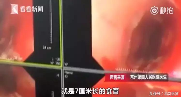 注意！食道裂开7厘米导致大出血这个吃饭的坏习惯你有吗？