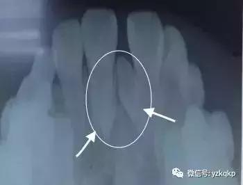 口腔科普儿童换牙常识,儿童换牙后牙缝大需要做矫正吗