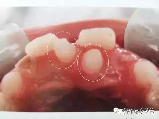 口腔科普儿童换牙常识,儿童换牙后牙缝大需要做矫正吗