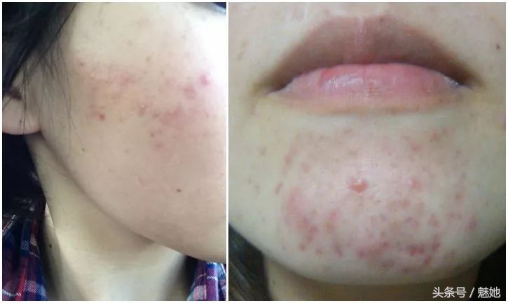 脸上痘印和红痘最佳消灭法,战痘神器工具