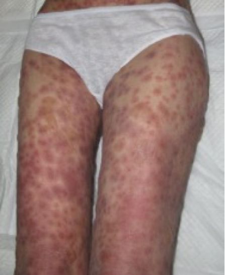 红包有不好的含义吗,额上长疱是什么原因