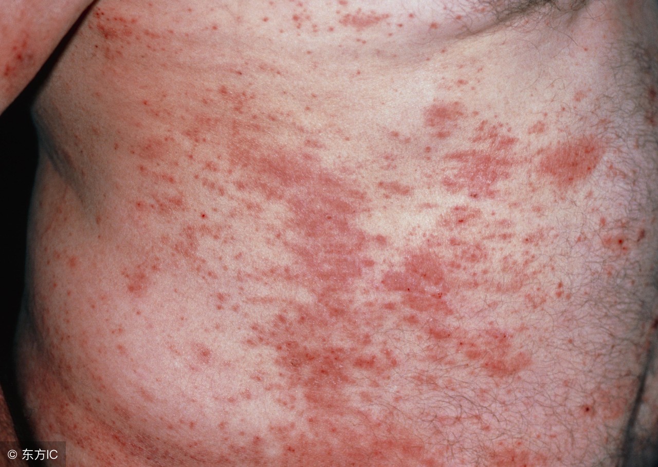 湿疹演变全过程,湿疹的临床表现和分期