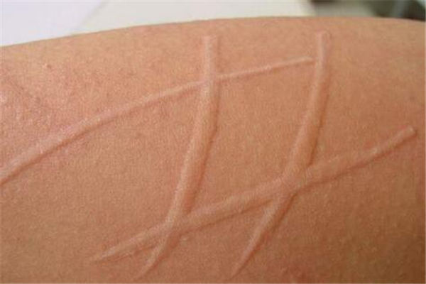 通宣理肺丸搭配什么中成药治麻疹,麻疹中医基本治疗原则是什么