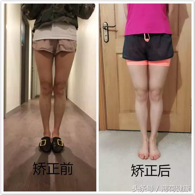 轻度XO型腿改善后,我的双腿明显变长