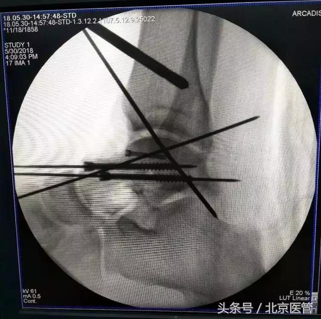 积水潭手术机器人,积水潭医院智能化机器人