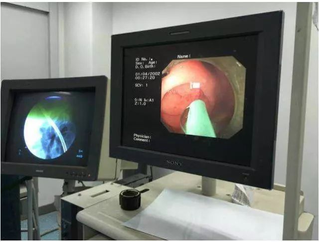 市县专家联动，淳安县中医院成功开展全县首例内镜下逆行阑尾炎治疗术（ERAT）