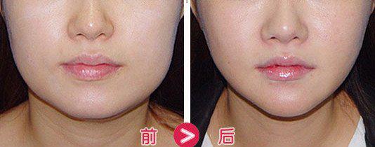 打瘦脸针会脸颊凹陷下垂吗,打瘦脸针脸颊凹陷是医生的问题吗