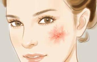 脸上角质层薄经常脸红怎么治,角质层薄弱脸红用什么甘油比较好