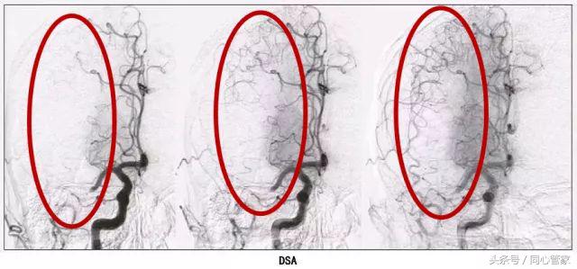 心脏血管堵塞能建立侧支循环吗,让心脏和血管强大的办法