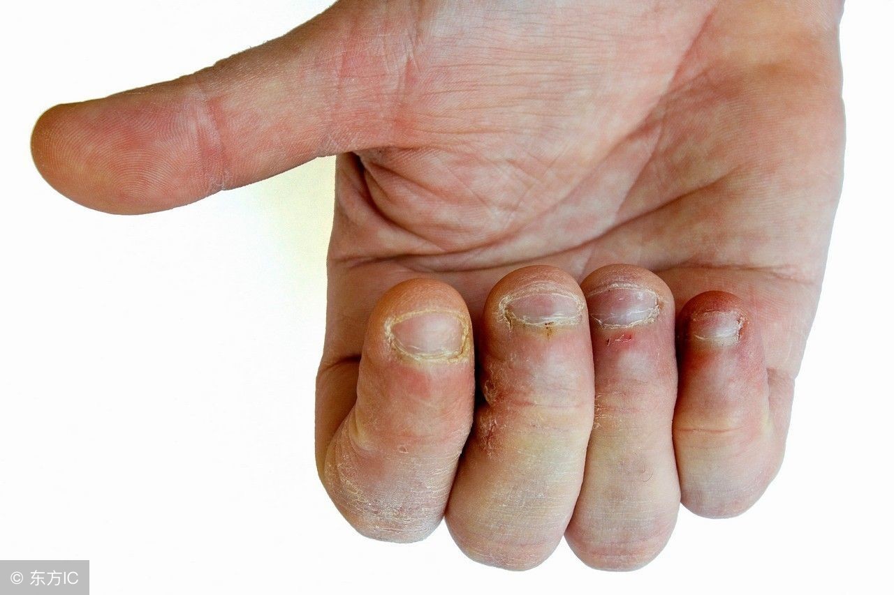 手指上的半月痕消失是什么原因,从手指看健康图解