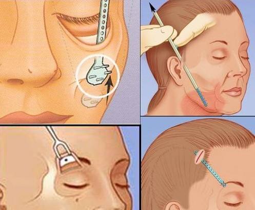 微创除皱手术与大拉皮除皱手术,微创除皱和拉皮的区别