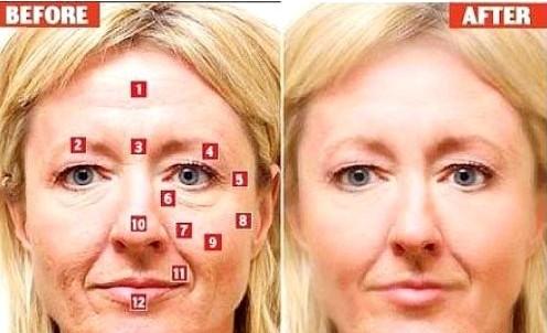 微创除皱手术与大拉皮除皱手术,微创除皱和拉皮的区别