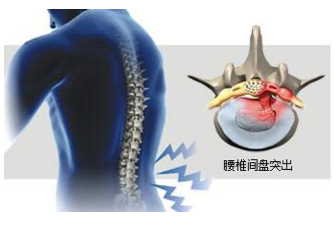 腰椎间盘突出有增生怎么保守治疗,腰椎间盘突出10mm还能保守治疗吗