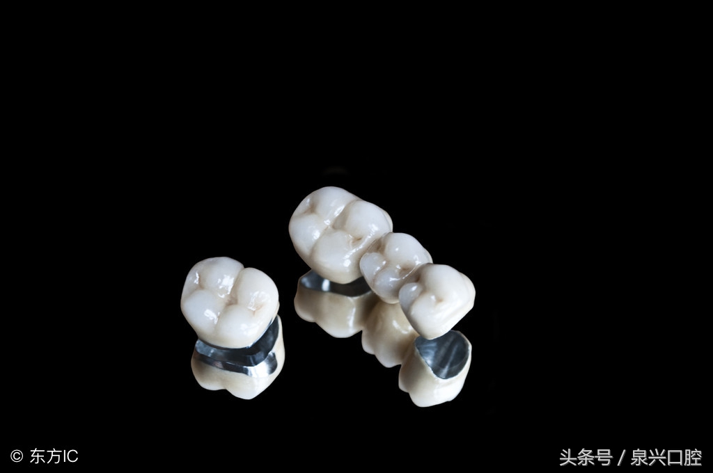 烤瓷牙优缺点,为什么不建议做烤瓷牙而是全瓷牙