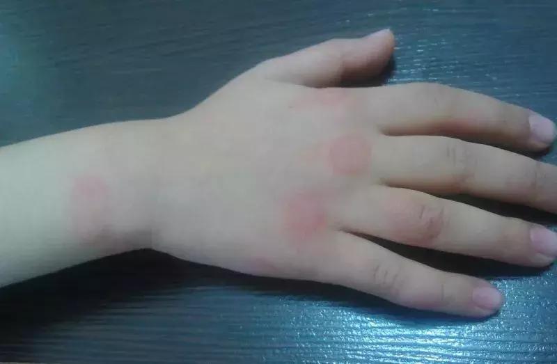 宝宝丘疹性荨麻疹后留下的红印子,宝宝身上出现红色荨麻疹