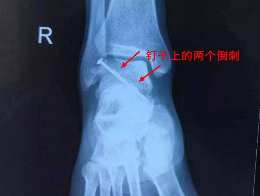 射钉枪打到手很痛怎么办,用射钉枪打钢钉