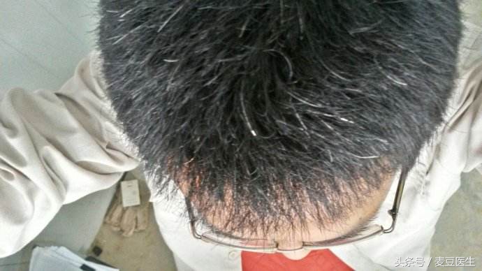 白发很多用什么方法乌黑头发,白发多不要慌教你改善白发问题