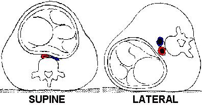 产科麻醉后低血压原因,仰卧位低血压综合征能剖腹产吗