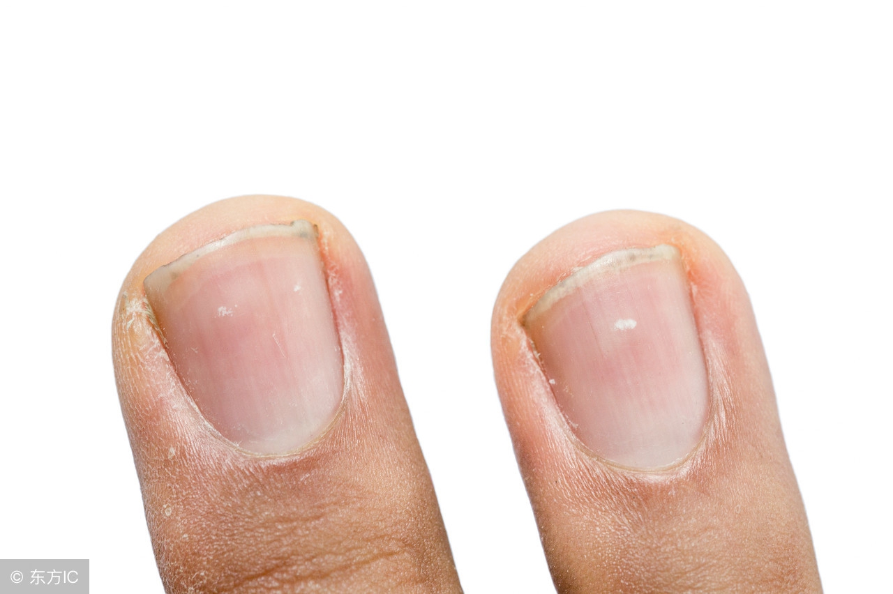 灰指甲应该多吃哪些食物，补充哪些营养素