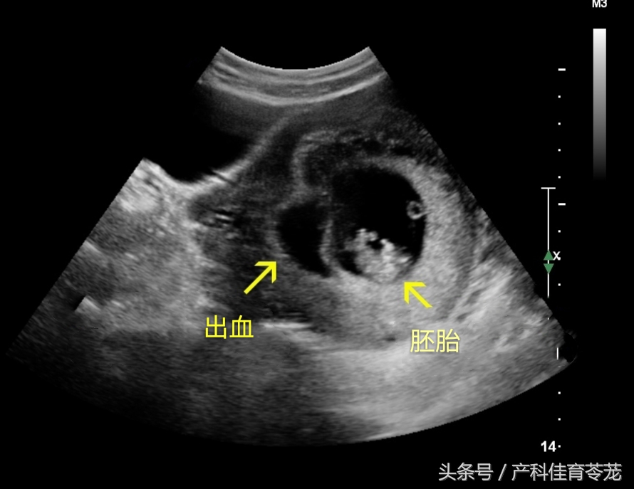 绒毛膜下血肿有保胎的必要吗,绒毛膜下血肿保胎最佳方法