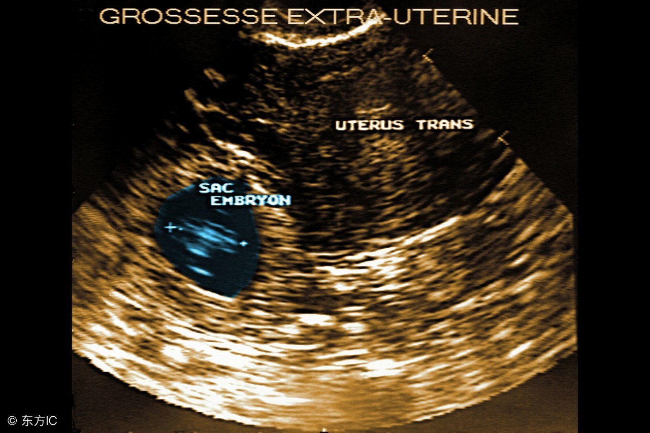 宫外孕引起的原因和男士有关系吗,宫外孕腿好胀好酸是什么原因