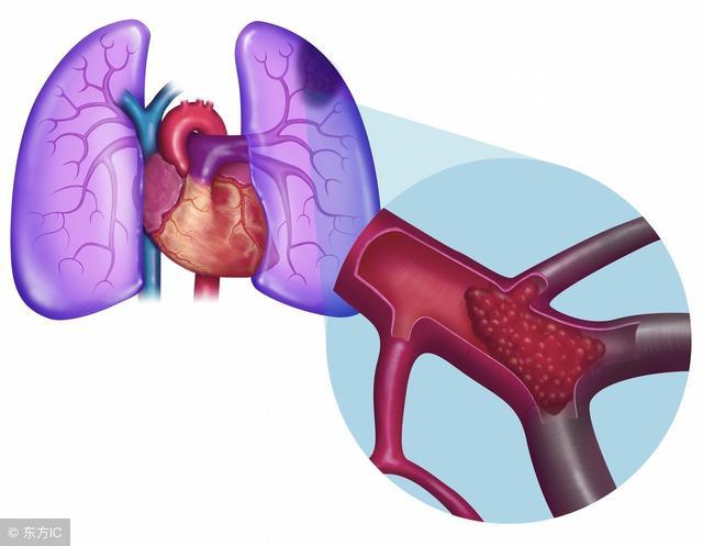 肺栓塞的症状有哪些呢？如何治疗