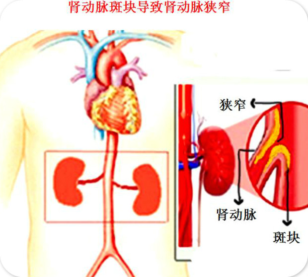 血管斑块咋回事？就像河流淤积的泥沙，有时没事，却怕在险滩出事