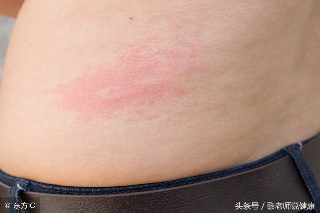 硫磺皂洗澡对人有伤害吗,硫磺皂洗澡对身体有什么影响