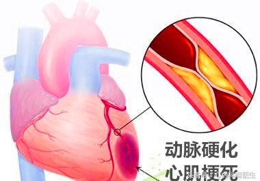 心绞痛需要放入支架吗,心绞痛要不要放支架